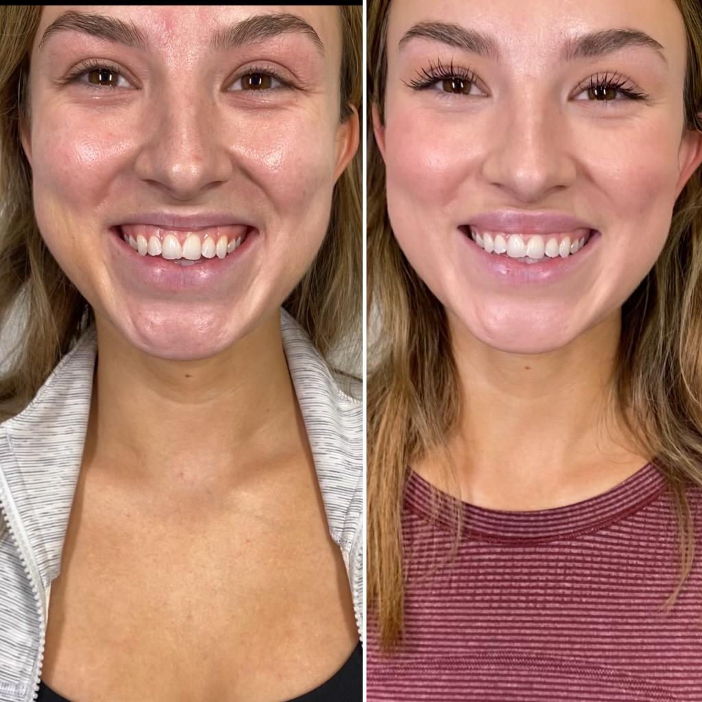 Botox Lip Flip Before & After Medical Spa Scottsdale The Perfect Dose