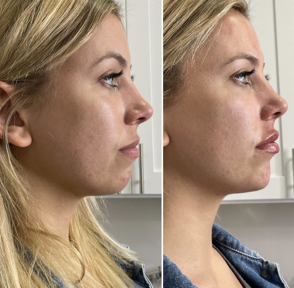 Chin Filler Before & After Medical Spa Scottsdale The Perfect Dose