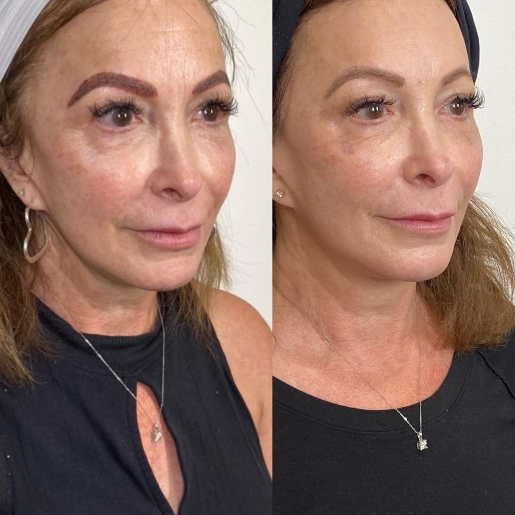 JLO GLOW Before & After Medical Spa Scottsdale The Perfect Dose