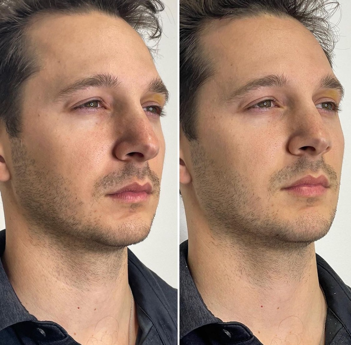 Jawline Filler Before & After Medical Spa Scottsdale The Perfect Dose