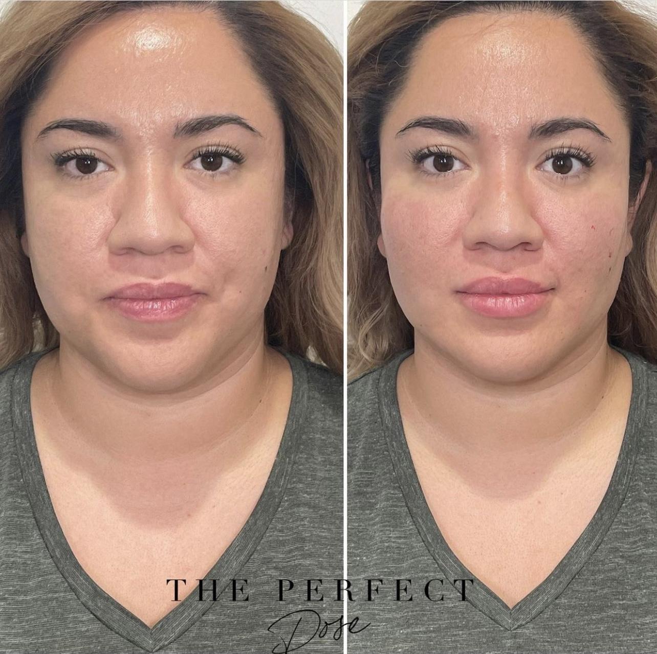 Kim K Package Before & After Medical Spa Scottsdale The Perfect Dose