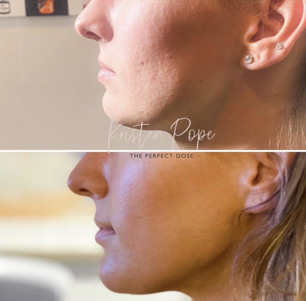 Kybella Before & After Medical Spa Scottsdale The Perfect Dose
