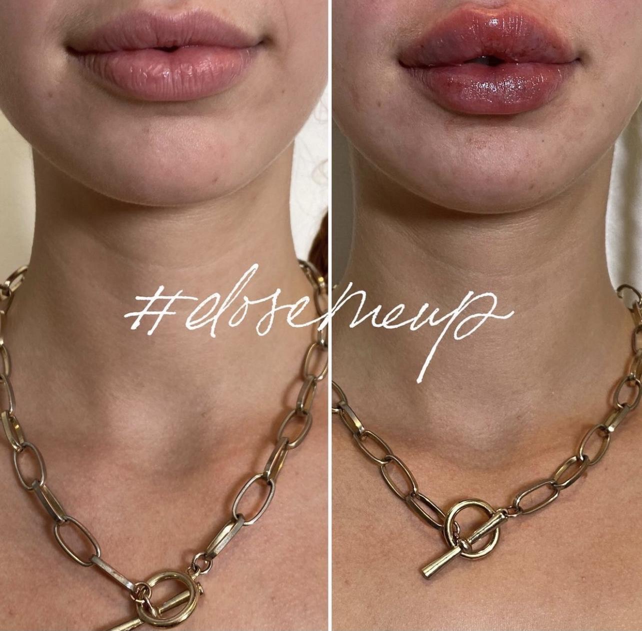 Mega Lip Plump Before & After Medical Spa Scottsdale The Perfect Dose