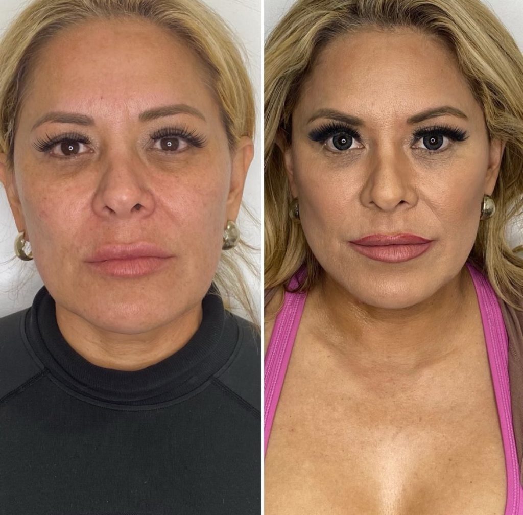 Non-surgical facelift Non-surgical facelift Before & After Medical Spa Scottsdale The Perfect Dose