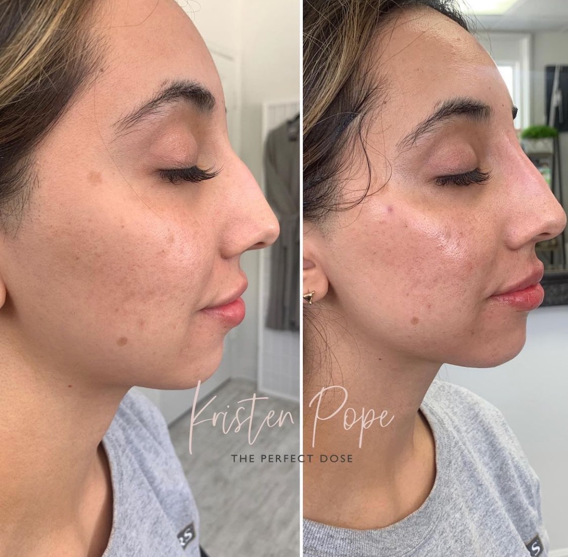 Non-surgical rhinoplasty Before & After Medical Spa Scottsdale The Perfect Dose