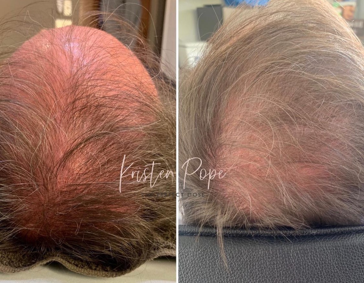 PRP Hair Restoration Before & After Medical Spa Scottsdale The Perfect Dose