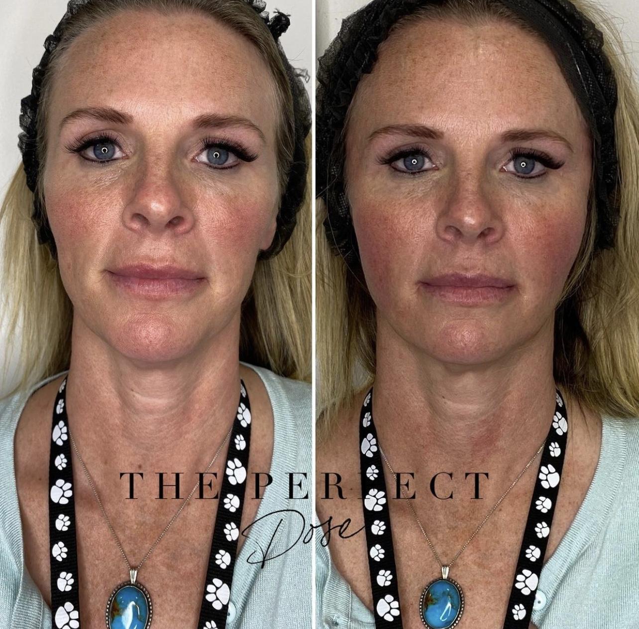Sculptra Before & After Medical Spa Scottsdale The Perfect Dose