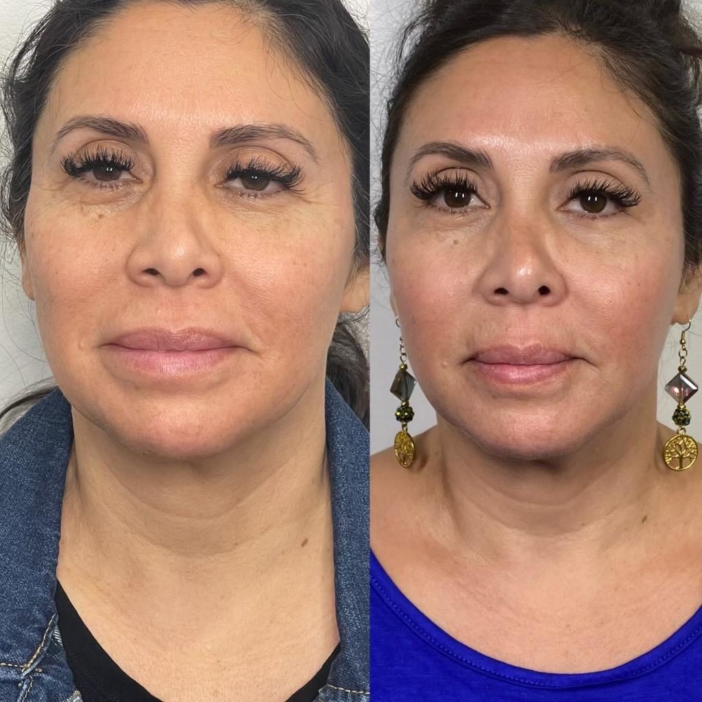 Thread & Filler Before & After Medical Spa Scottsdale The Perfect Dose