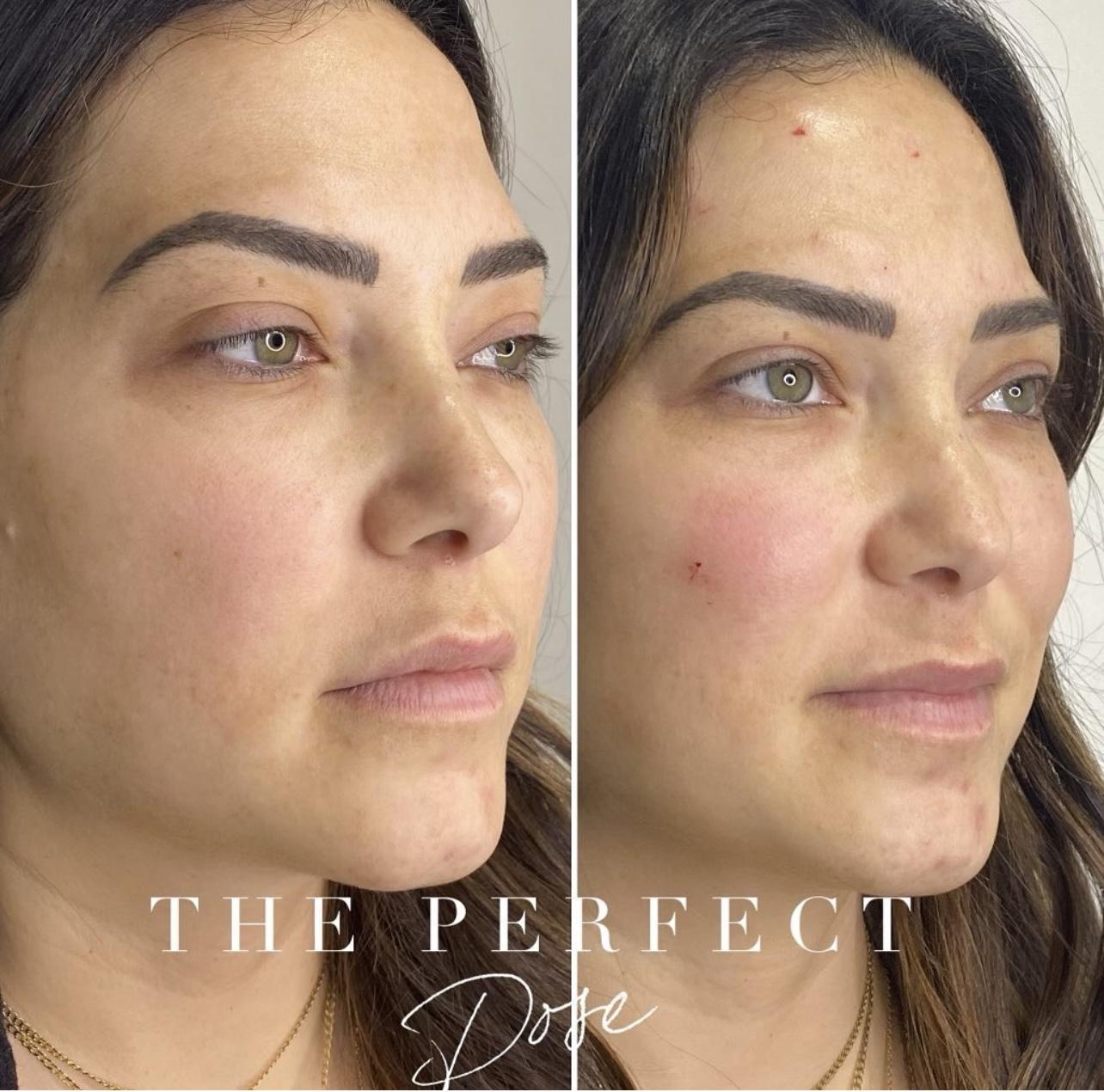 Under eye filler Before & After Medical Spa Scottsdale The Perfect Dose
