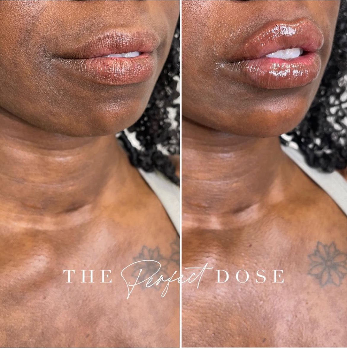 Lip & Chin Before & After Medical Spa Scottsdale The Perfect Dose