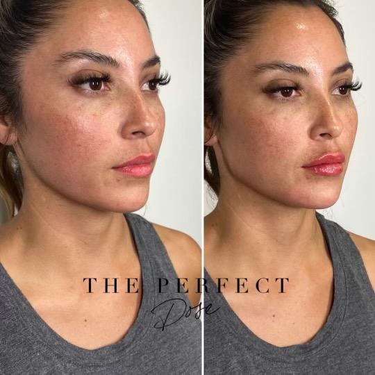 jawline snatch Before & After Medical Spa Scottsdale The Perfect Dose