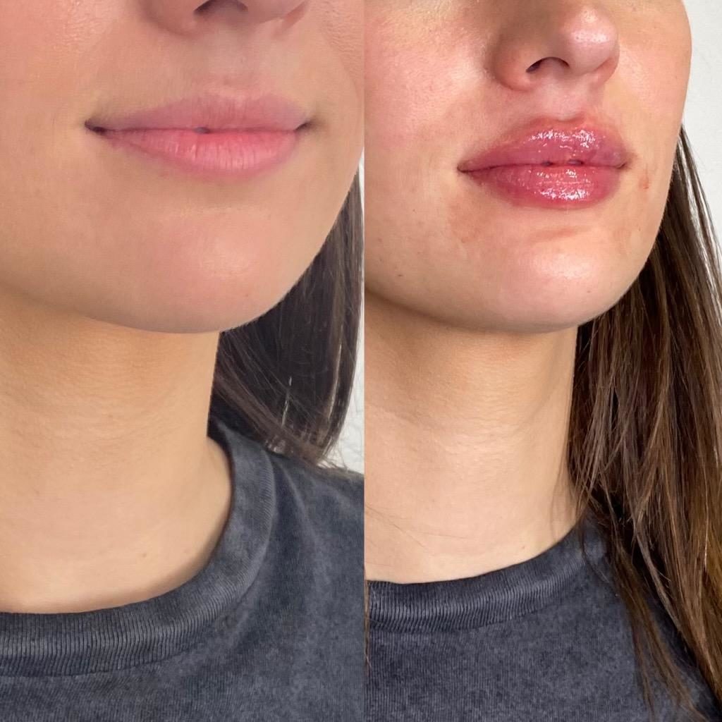 lip filler Before & After Medical Spa Scottsdale The Perfect Dose
