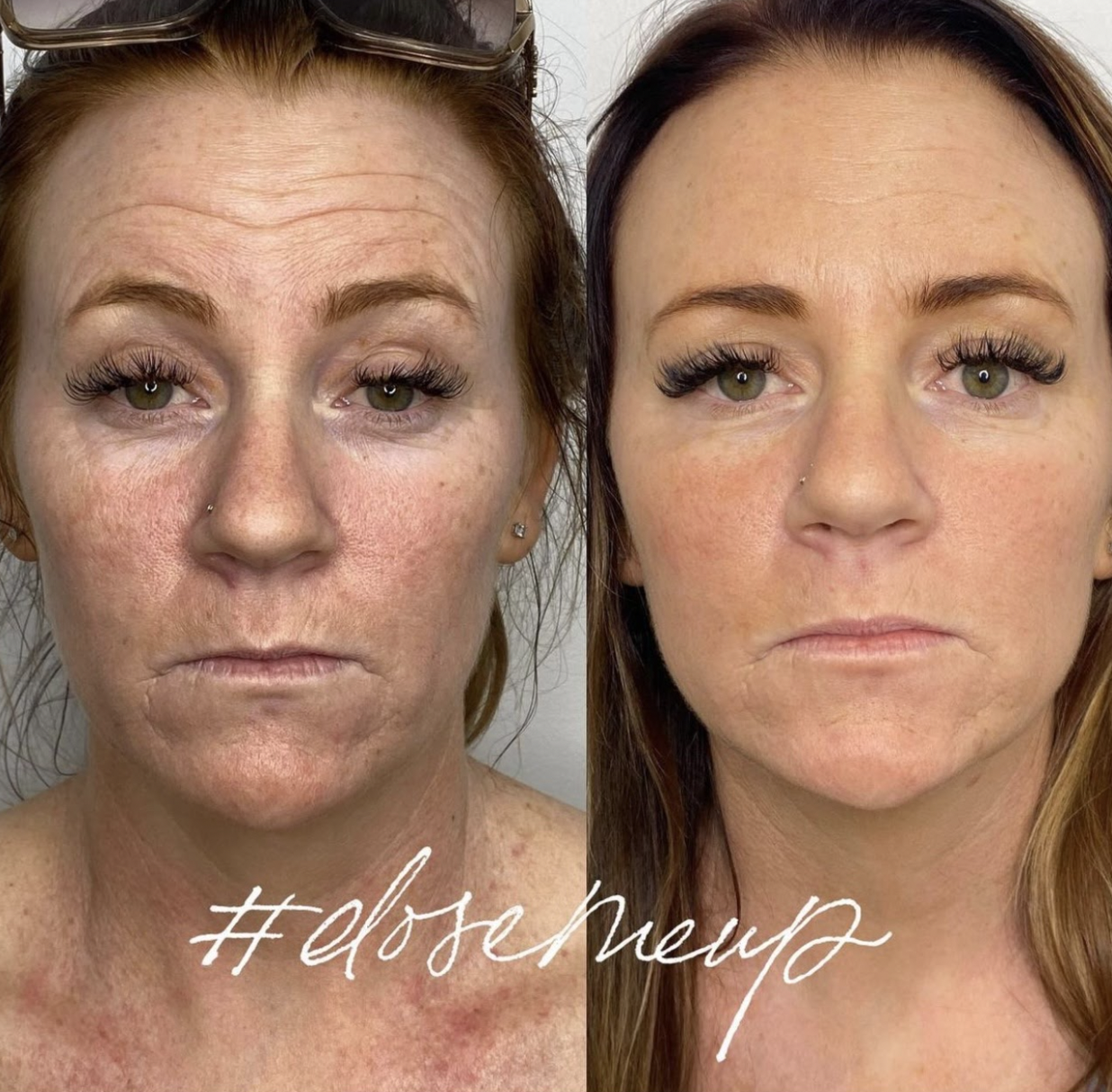 Botox Before & After Medical Spa Scottsdale The Perfect Dose