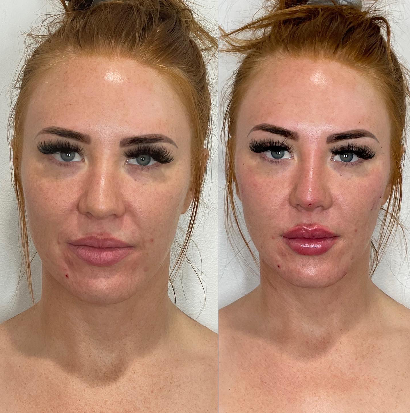 Non-surgical Rhinoplasty Before and After Photo by The Perfect Dose in Scottsdale, AZ