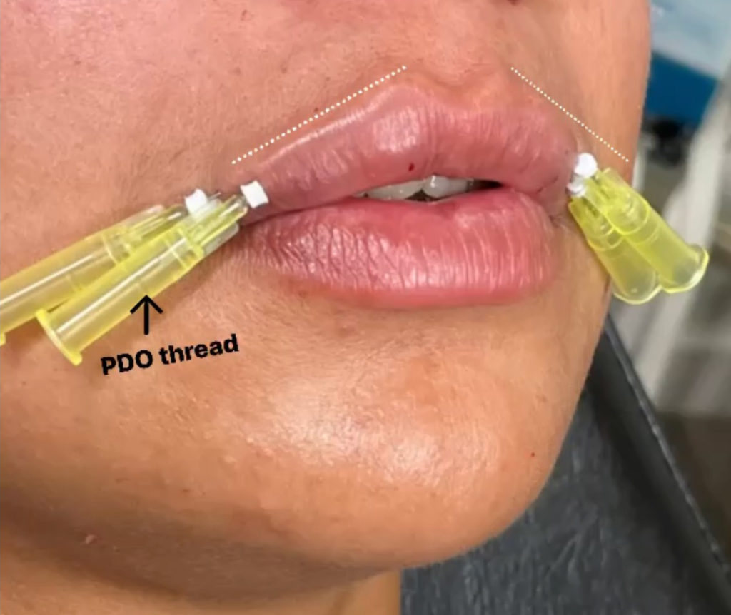 Mega Lip Plump Before and After Photo by The Perfect Dose in Scottsdale, AZ