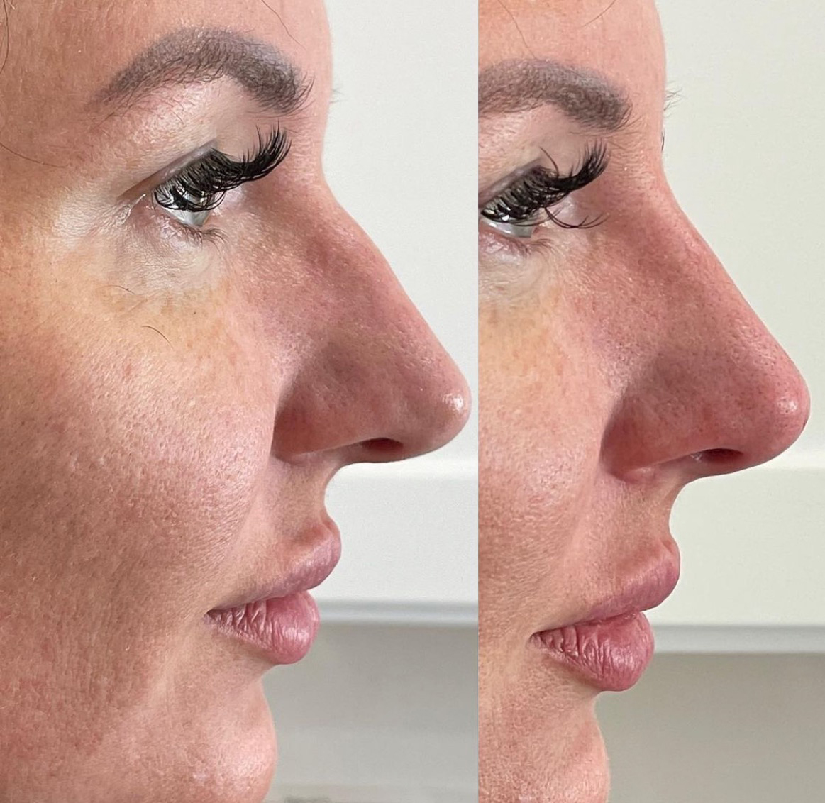Non Surgical Rhinoplasty Before and After Photo by The Perfect Dose in Scottsdale, AZ