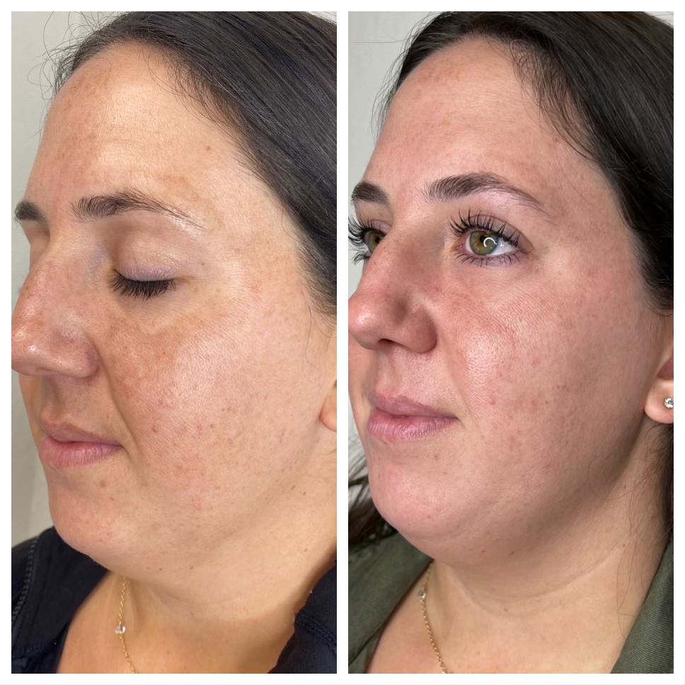 VI Peel Before & After Medical Spa Scottsdale The Perfect Dose