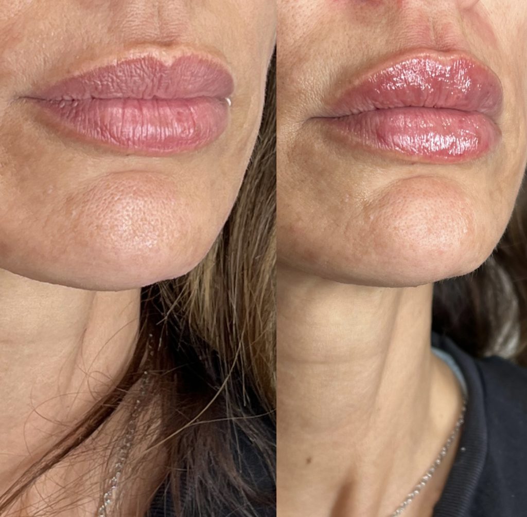 Lip Filler Before and After photo by The Perfect Dose in Scottsdale, AZ